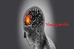 سکته مغزی چیست و چگونه اتفاق می افتد